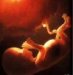 syphilis-congenitalis-tarda-pozni-kongenitalni-sifilis