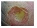 stuccokeratosis