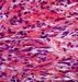 fasciitis-nodularis-pseudosarcomatosa