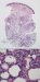 idiopatski-lobularni-panikulitis