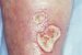 erythrocyanosis-crurum-puellarum