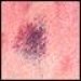 urticaria-vasculitis