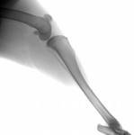 patella luxation surgery cost in the uk