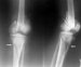 interkondilarni-prelomi-butne-kosti-fractura-intercondylaris-femoris