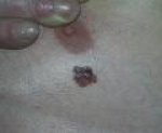 Tumor Koze