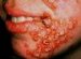 impetigo-contagiosa