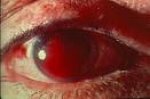 Hyphema+pictures