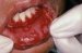 zapaljenje-oralne-sluzokože-stomatitis
