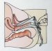 vaginalna-intraepitelna-neoplazija