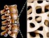 osteoporoza-bolest-koja-razara-kosti