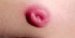 lymphadenosis-cutis-benigna