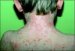 ichthyosis-linearis-circumflexa