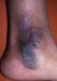 lichen-simplex-chronicus