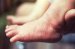 acropustulosis-infantilis