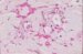 amyloidosis-cutis-nodularis-atrophicans