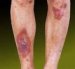 necrobiosis-lipoidica-diabeticorum