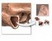 mastoiditis-latens