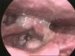 tumor-congenitales-laryngis