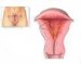 akutni-endometritis
