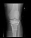 prelomi-kondila-tibije-fractura-condily-tibiae