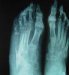 osteomijelitis