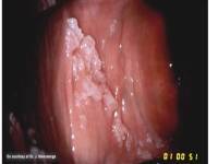 humani papiloma virus kod muskaraca simptomi
