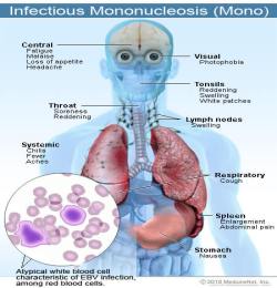 mononukleoza