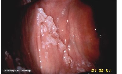 Humani papiloma virus kod muskaraca simptomi
