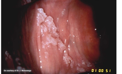 Virus hpv quanto dura, Virus papilloma quanto dura - Papilom pe globul ocular