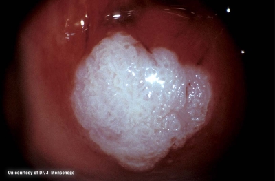 hpv papilloma vírus sta je