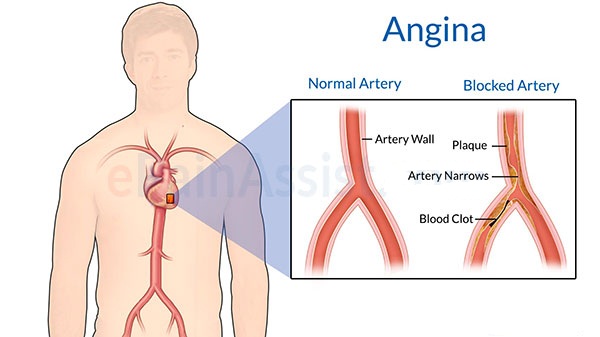 angina-pektoris