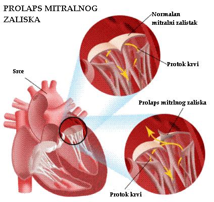 Prolaps-mitralnog-zaliska