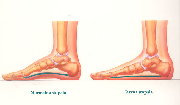 ravna-stopala