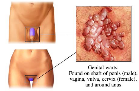 anglogenitalne-bradavice2