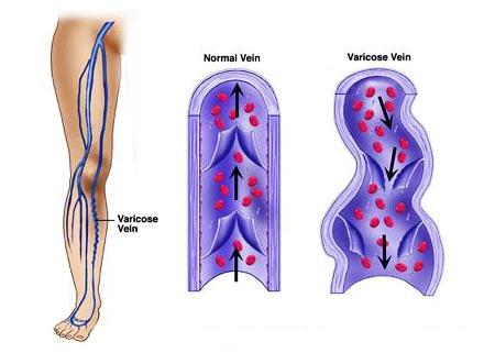 kako-nastaju-prosirene-vene