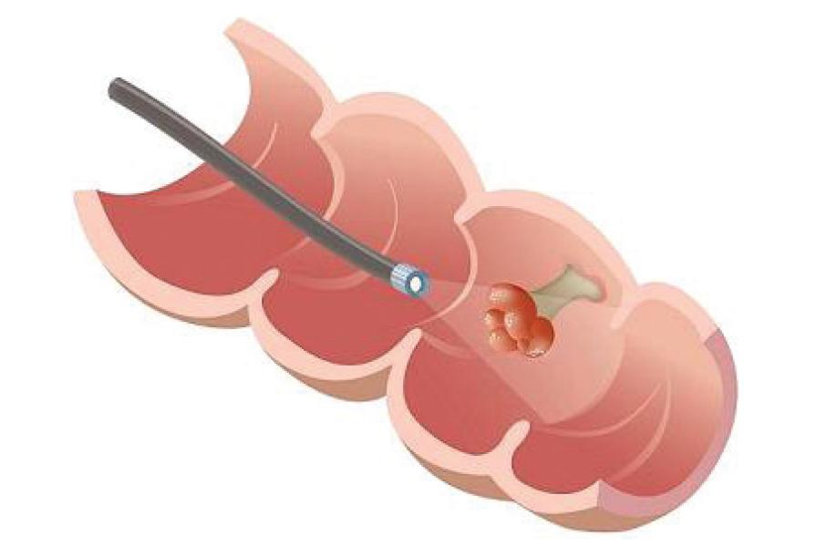 Биопсия пищевода. Эндоскопическая петлевая электроэксцизия полипов. Эндоскопическая полипэктомия толстой кишки. Полип прямой кишки эндоскопия.