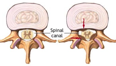 Spinalni-kanal