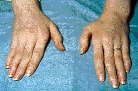 bol i deformacija zglobova prstiju