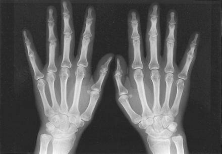 Reumatoidni artritis uništava zglobove, otkrijte ga na vrijeme