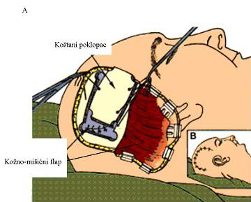 Prikaz-kraniotomije