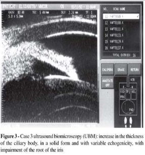 ultrazvucna-biomikroskopija