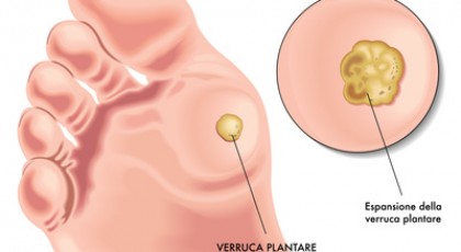 verruca-vulgaris