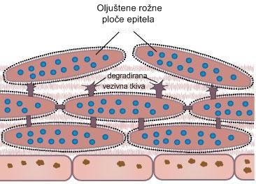 deskvamacija-celijskog-plocastog-epitela