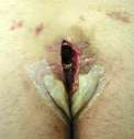 Pilonidalni sinus (coccygeal sinus)
