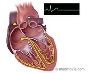 Bolest sinusnog čvora (sick sinus syndrome)