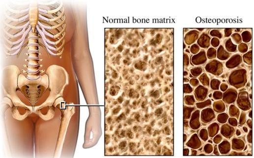 Gustina kostiju u starosti i dizanje tegova