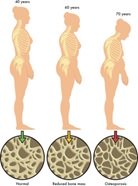 Osteoporoza – bolest dama zrele životne dobi