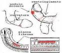 Induratio penis plastica