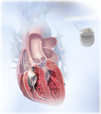 Resinhronizaciona terapija srčane insuficijencije
