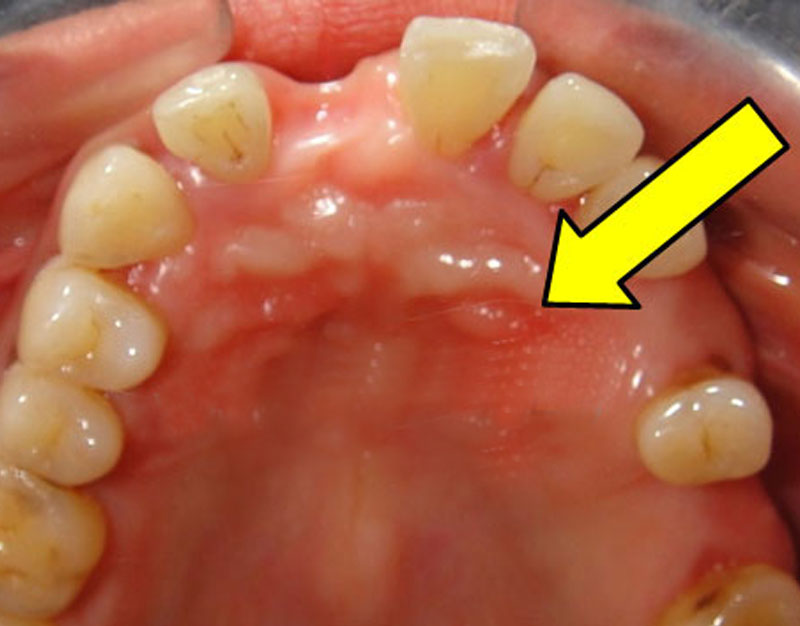 Protetski stomatitis